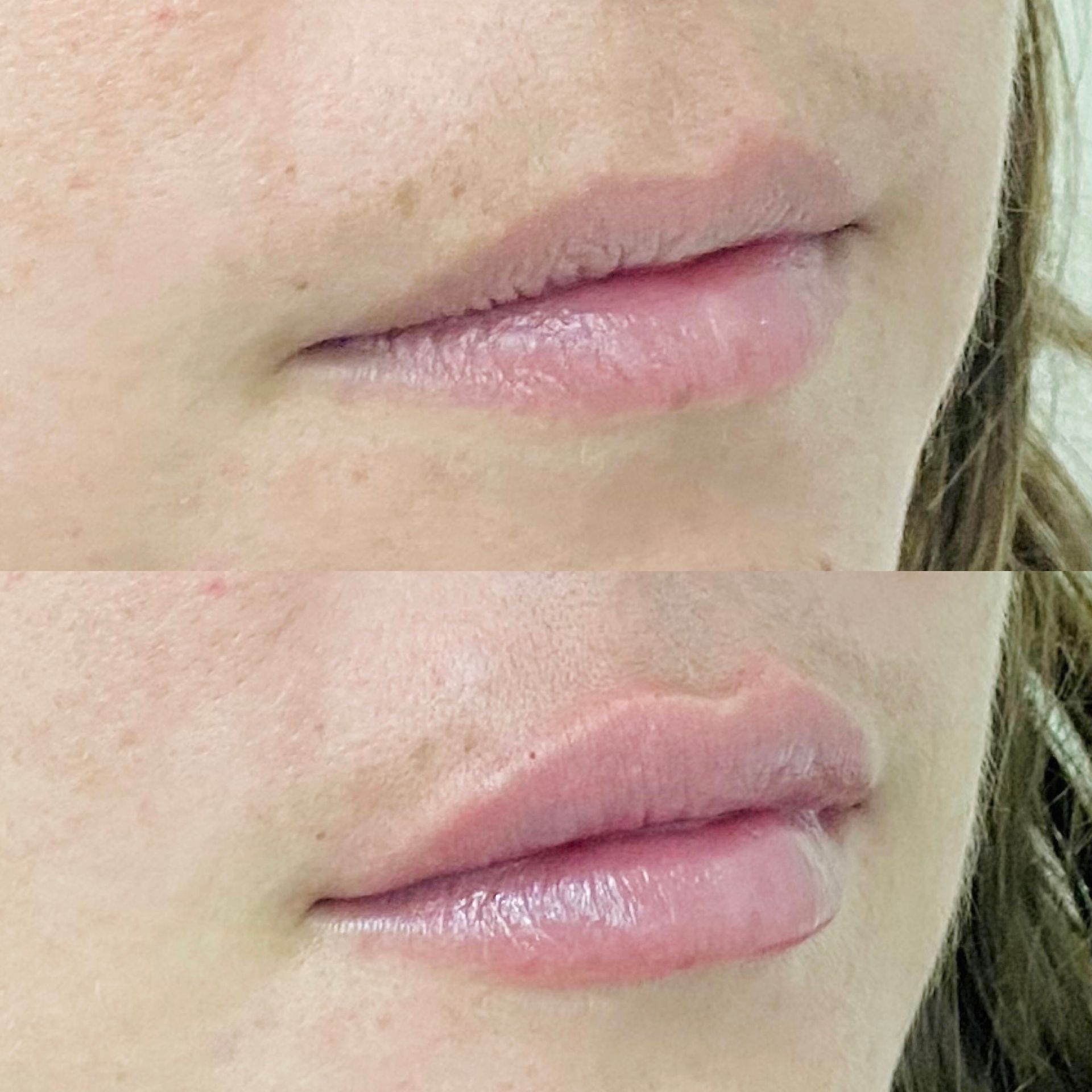 Lipfillers Amsterdam: volle, symmetrische lippen | Cosmopolitan