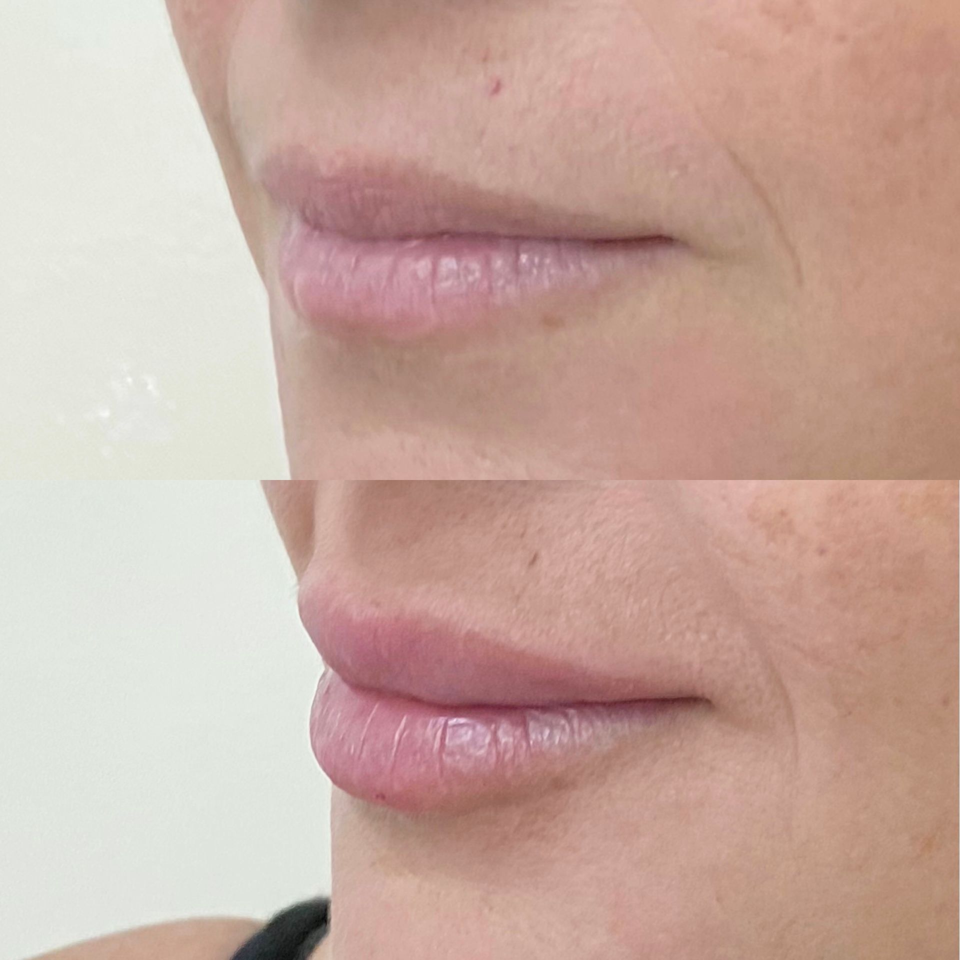 Lipfillers Amsterdam: volle, symmetrische lippen | Cosmopolitan