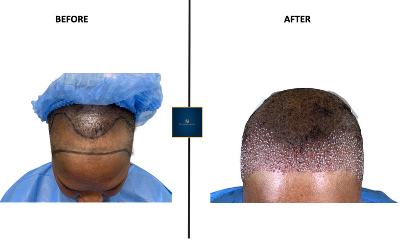 Before-and-after scalp photos showing hair growth progress under a blue surgical cap.