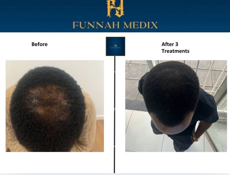 Before-and-after hair treatment photos showing a thinning scalp and fuller hair growth.