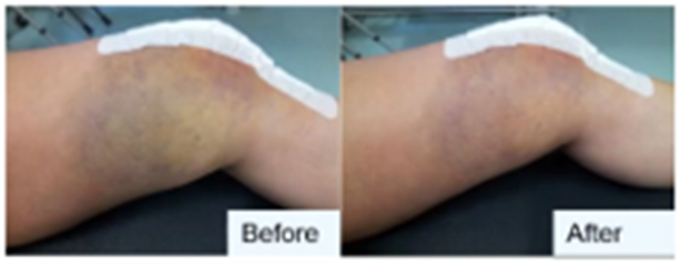 Before-and-after side view of a bent arm, showing reduced swelling after treatment.