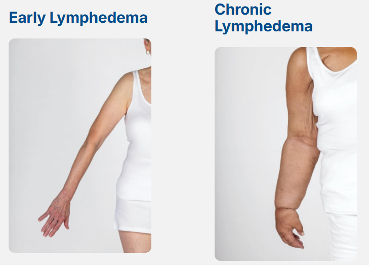 Early and chronic lymphedema shown side by side, with a swollen arm in the chronic stage.