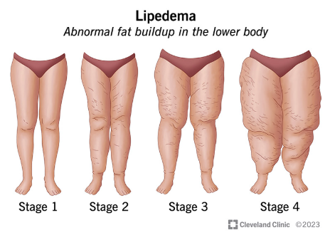 Diagram of lipedema showing abnormal fat buildup in the lower body across stages 1 to 4