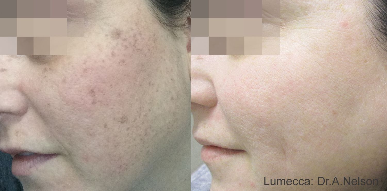 comparison of a hand, showing hair before and reduced hair after the Lumecca laser treatment in Nacogdoches TX
