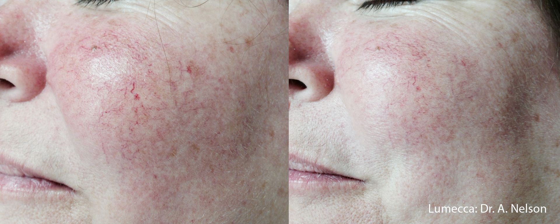 comparison of a hand, showing hair before and reduced hair after the Lumecca laser treatment in Nacogdoches TX