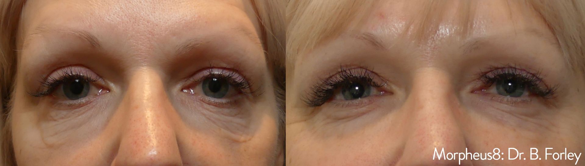 Skin resurfacing laser treatment at Wagoner Family Health Clinic in Nacogdoches TX