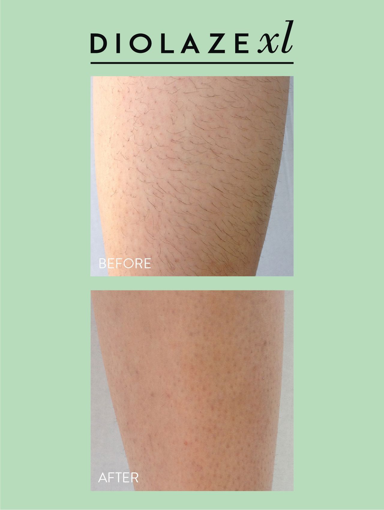 Before and after comparison of a leg, showing hair before and reduced hair after the DiolazeXL laser treatment in Nacogdoches TX