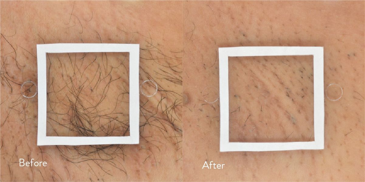 Before and after comparison of a leg, showing hair before and reduced hair after the DiolazeXL laser treatment in Nacogdoches TX