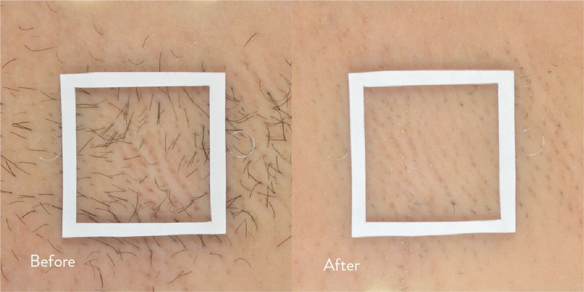 Before and after comparison of a leg, showing hair before and reduced hair after the DiolazeXL laser treatment in Nacogdoches TX