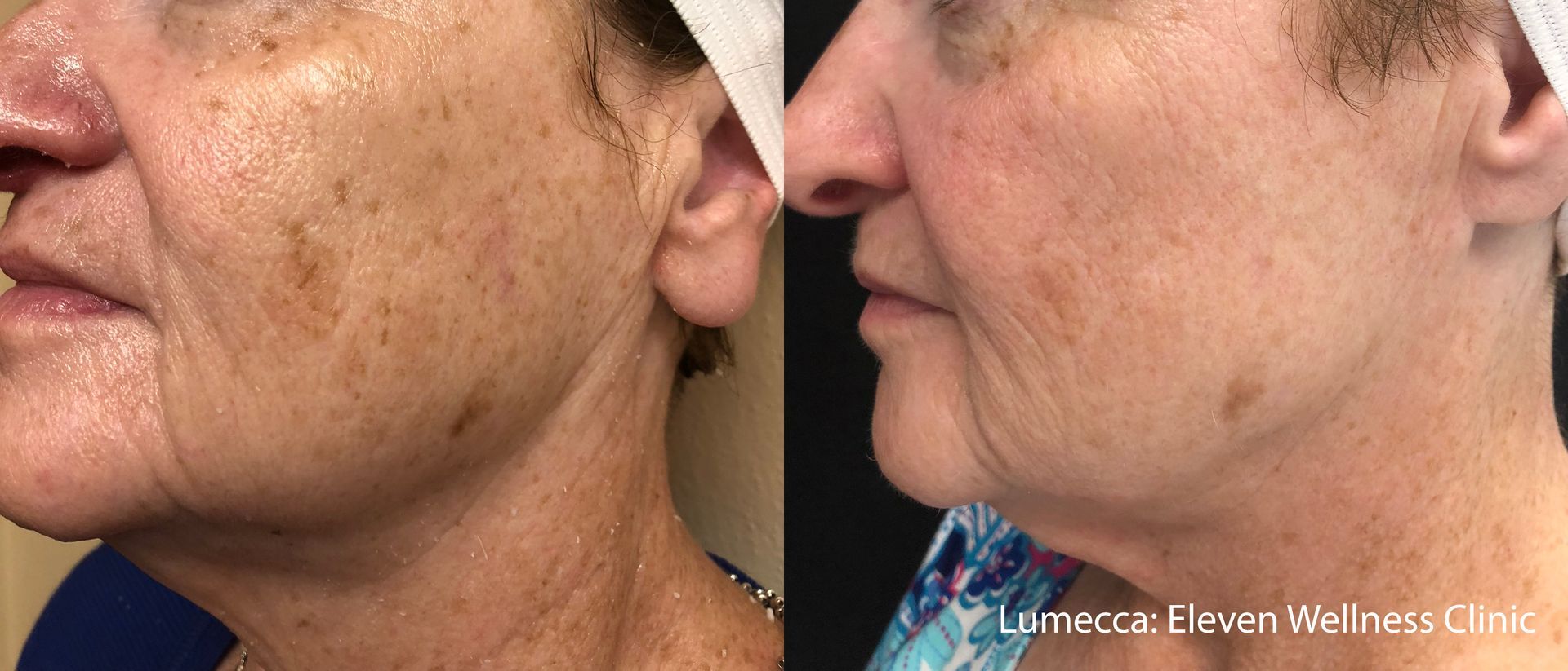 comparison of a hand, showing hair before and reduced hair after the Lumecca laser treatment in Nacogdoches TX