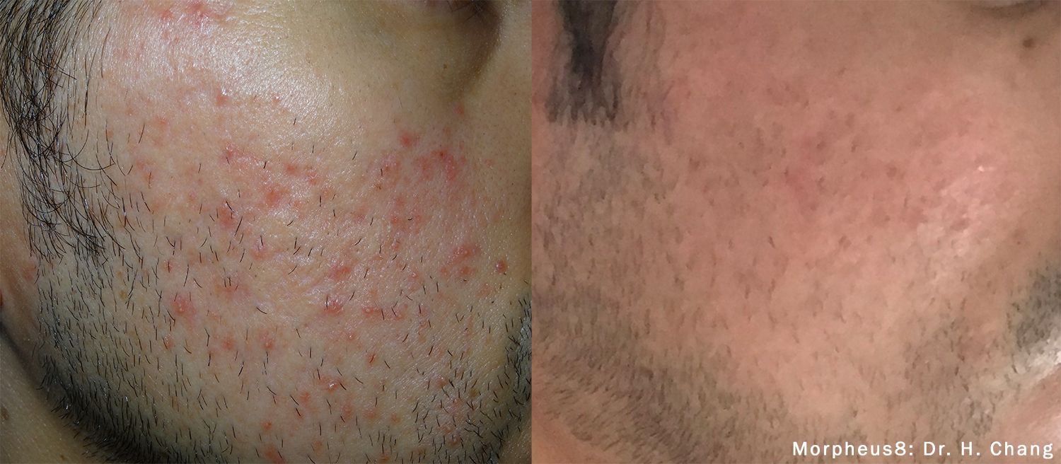Scar reduction therapy at Wagoner Family Health Clinic Nacogdoches TX