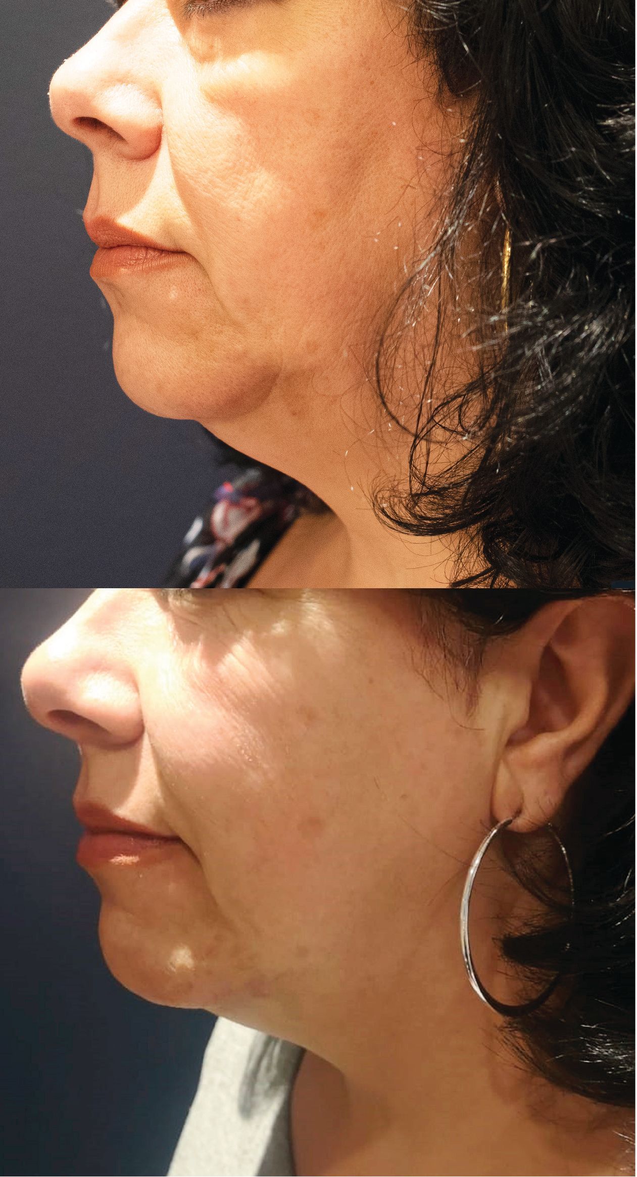 Laser hair removal services at Wagoner Family Health Clinic Nacogdoches TX