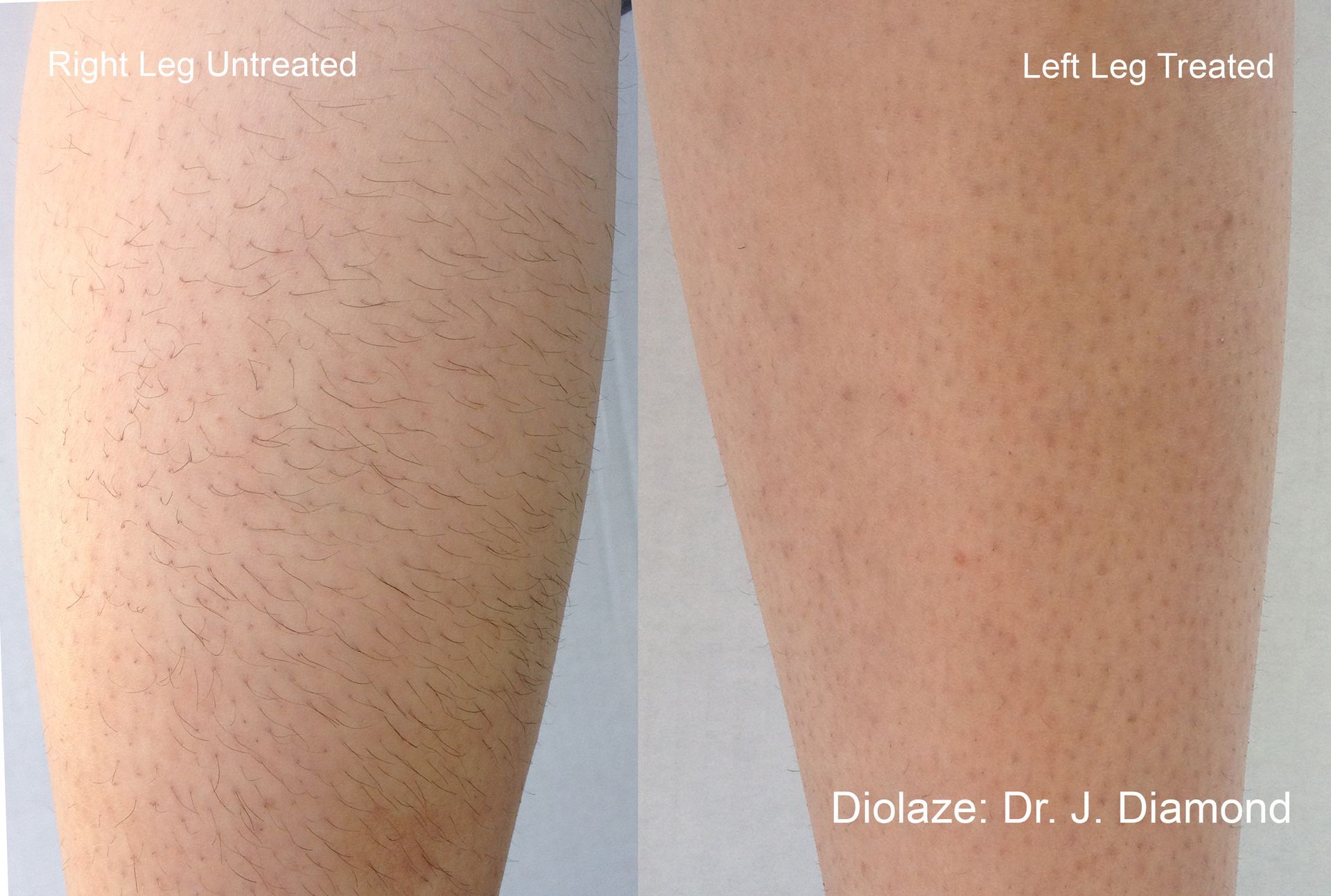 Before and after comparison of a leg, showing hair before and reduced hair after the DiolazeXL laser treatment in Nacogdoches TX