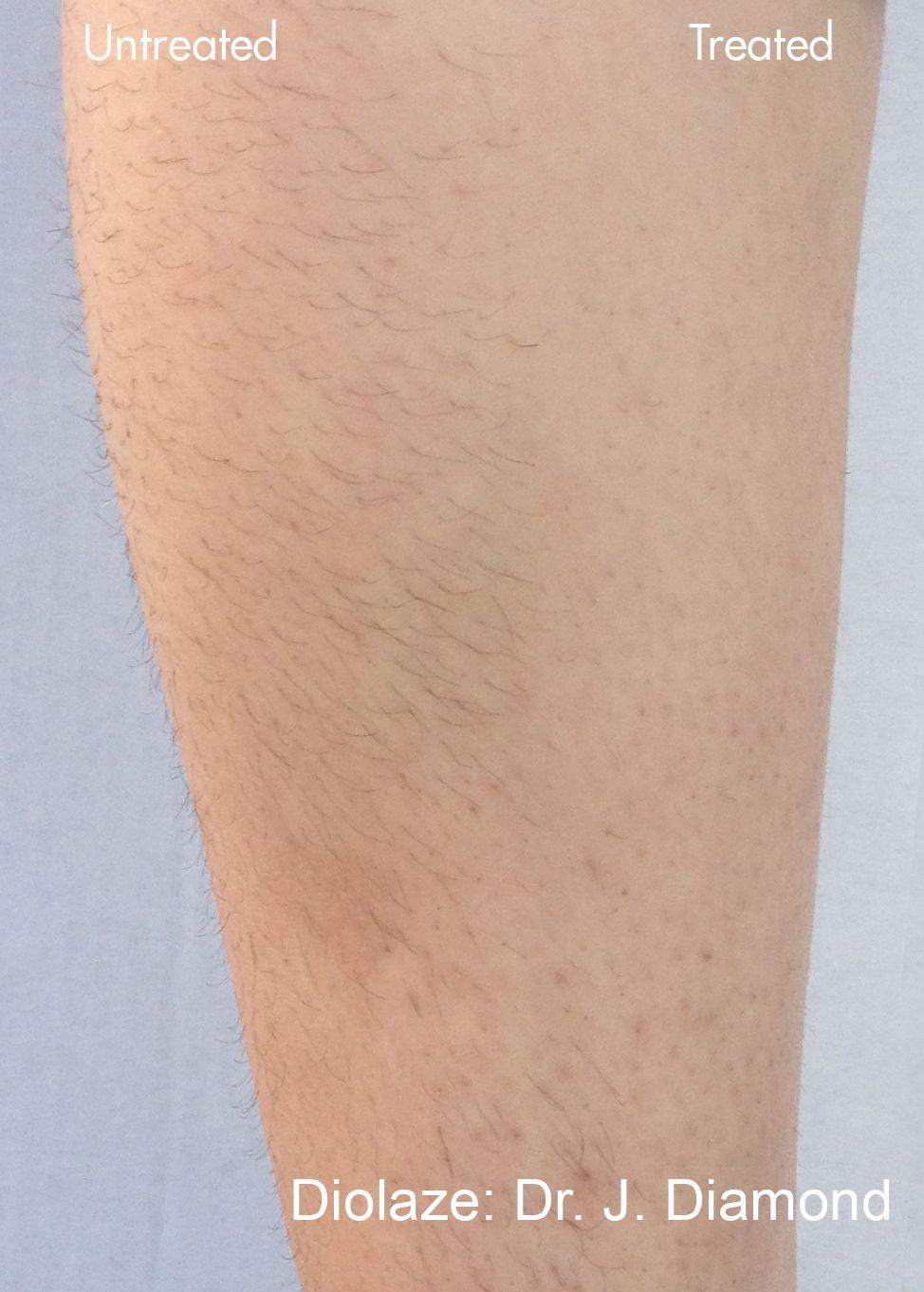 Before and after comparison of a leg, showing hair before and reduced hair after the DiolazeXL laser treatment in Nacogdoches TX