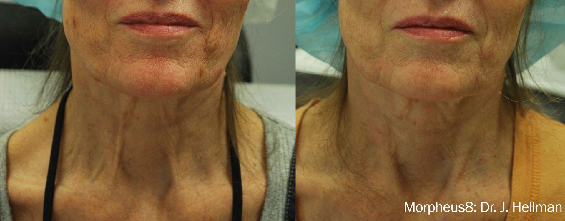 Wrinkle Treatment services at Wagoner Family Health Clinic Nacogdoches TX