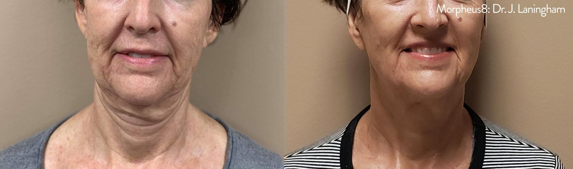 Wrinkle Treatment services at Wagoner Family Health Clinic Nacogdoches TX