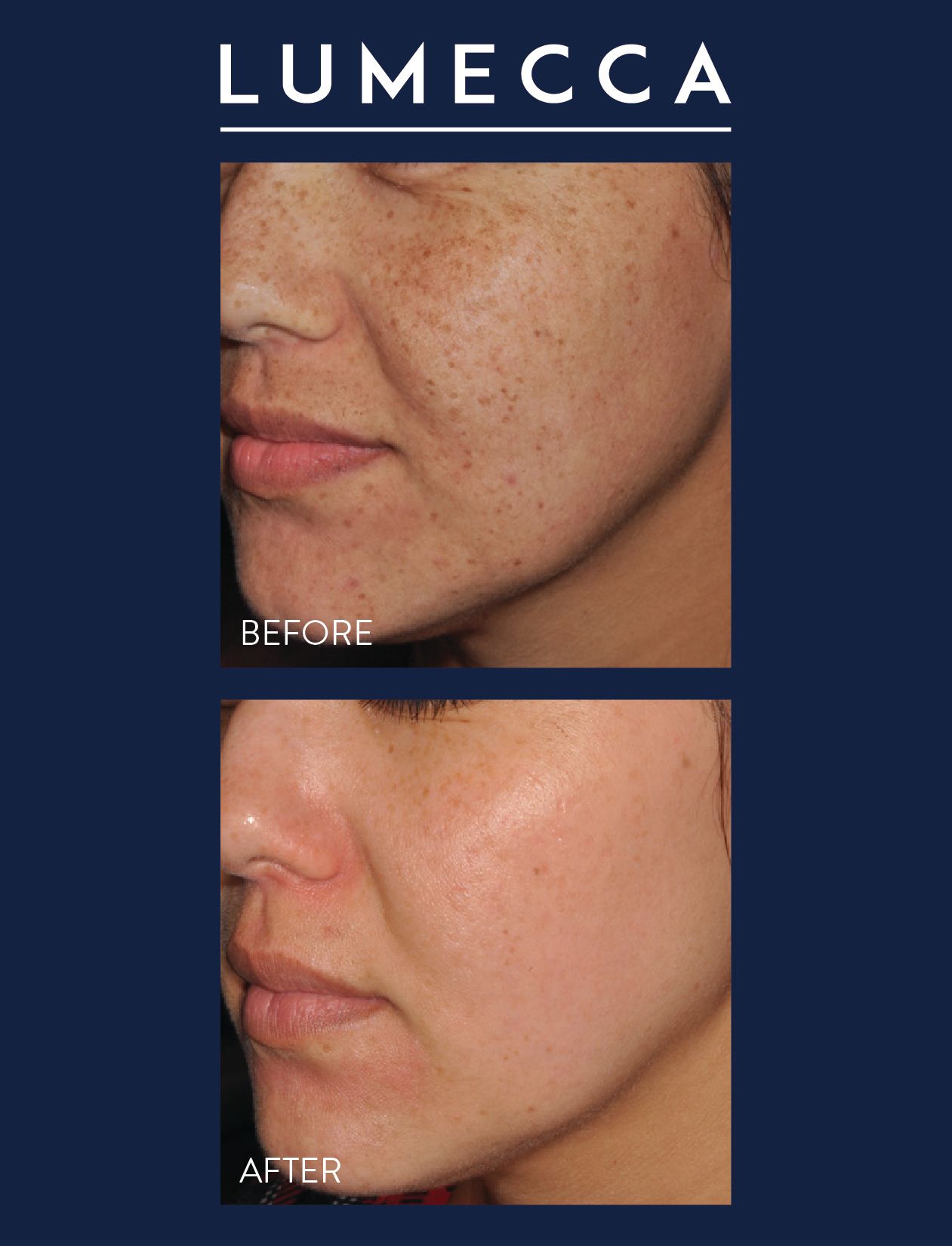 Before and after comparison of a face after Lumecca laser treatment in Nacogdoches TX