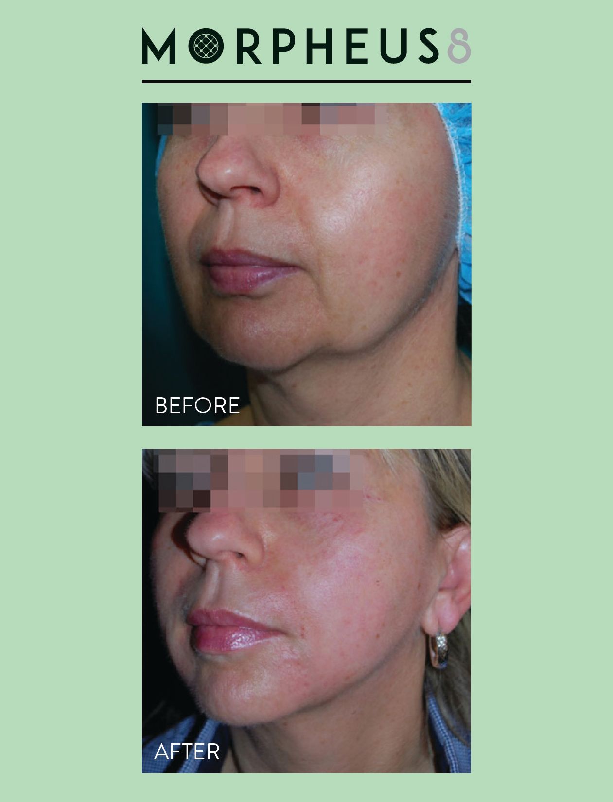 Before and after comparison of a face showing hair before and reduced hair after Morpehus8 laser treatment in Nacogdoches TX