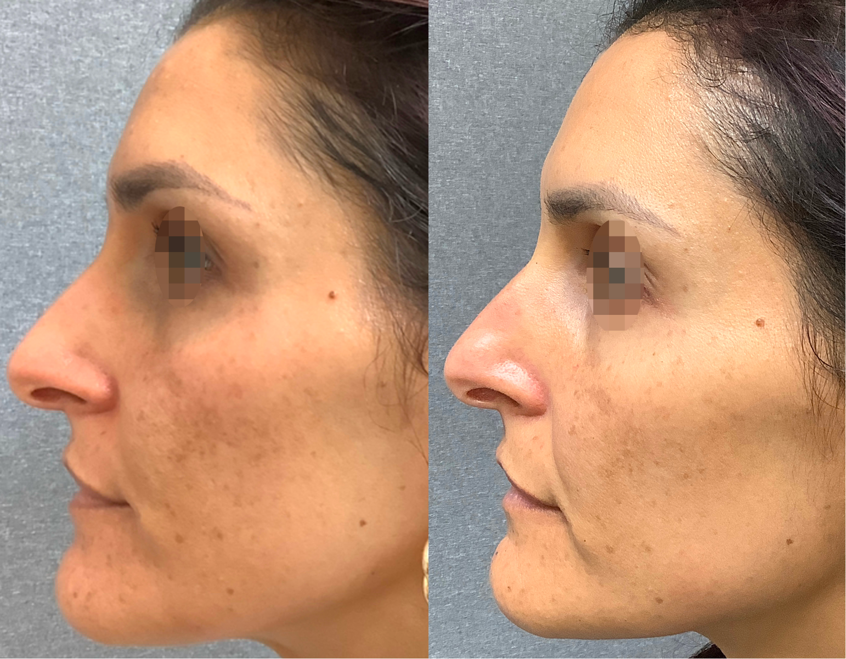Scar reduction therapy at Wagoner Family Health Clinic Nacogdoches TX