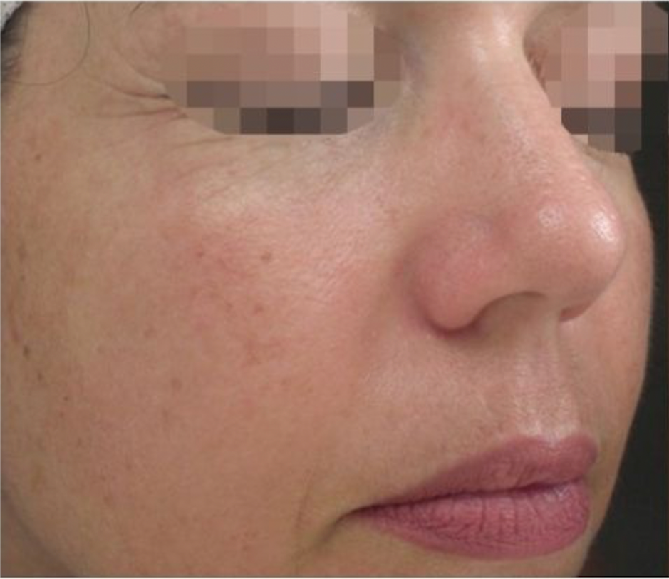Scar reduction therapy at Wagoner Family Health Clinic Nacogdoches TX