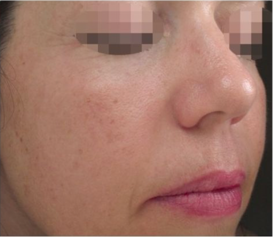 Anti-aging skin therapy at Wagoner Family Health Clinic Nacogdoches TX