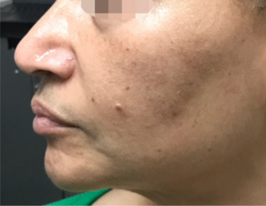 Anti-aging skin therapy at Wagoner Family Health Clinic Nacogdoches TX