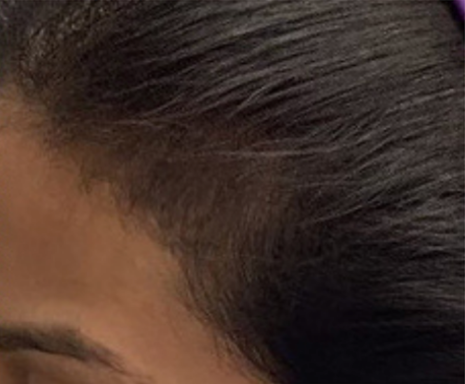 Hair Thinning treatments at Wagoner Family Health Clinic Nacogdoches TX
