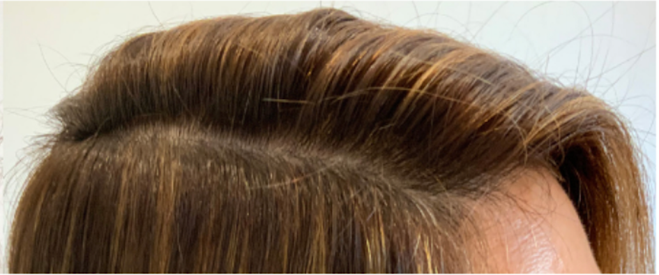 Hair Loss treatments at Wagoner Family Health Clinic Nacogdoches TX