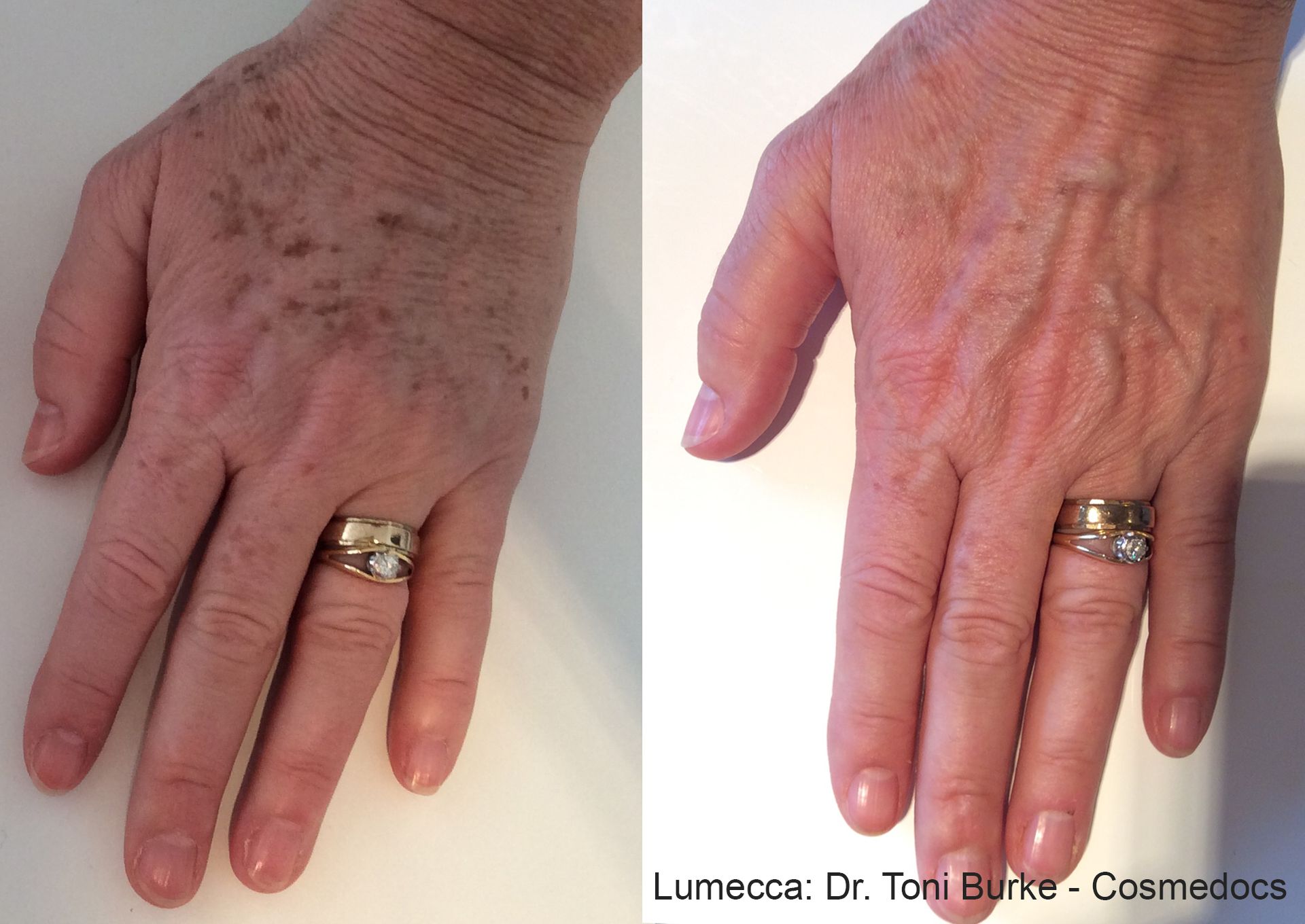 comparison of a hand, showing hair before and reduced hair after the Lumecca laser treatment in Nacogdoches TX