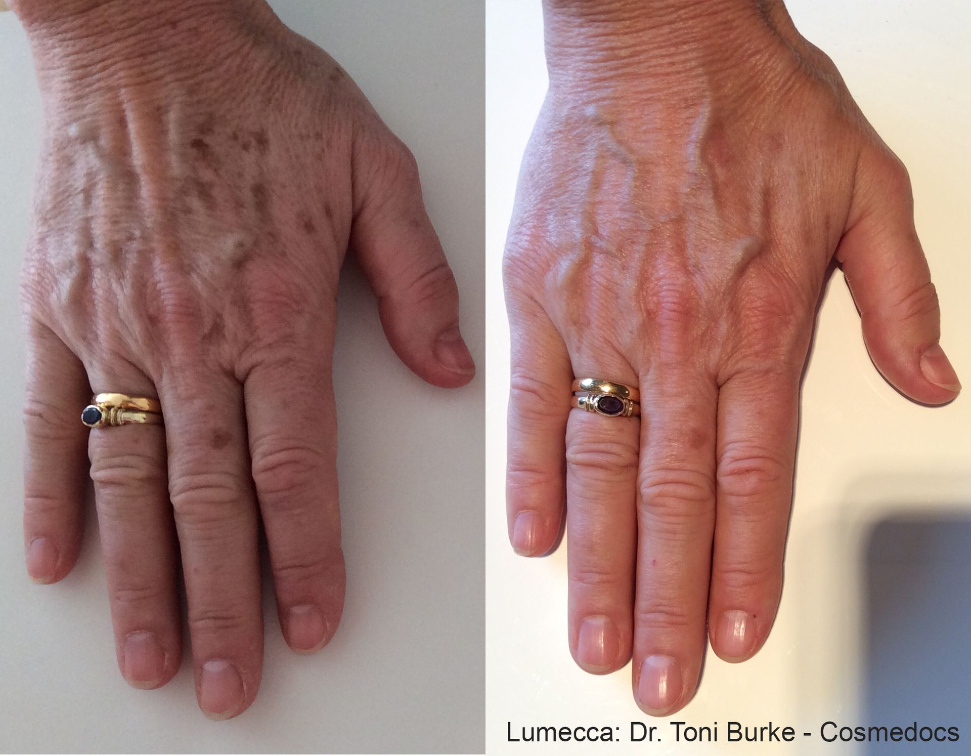 comparison of a hand, showing hair before and reduced hair after the Lumecca laser treatment in Nacogdoches TX