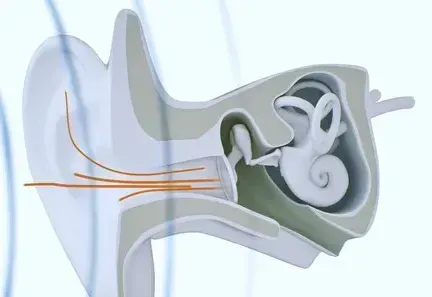 Cross-section of an ear showing the outer, middle, and inner ear structures with sound waves entering