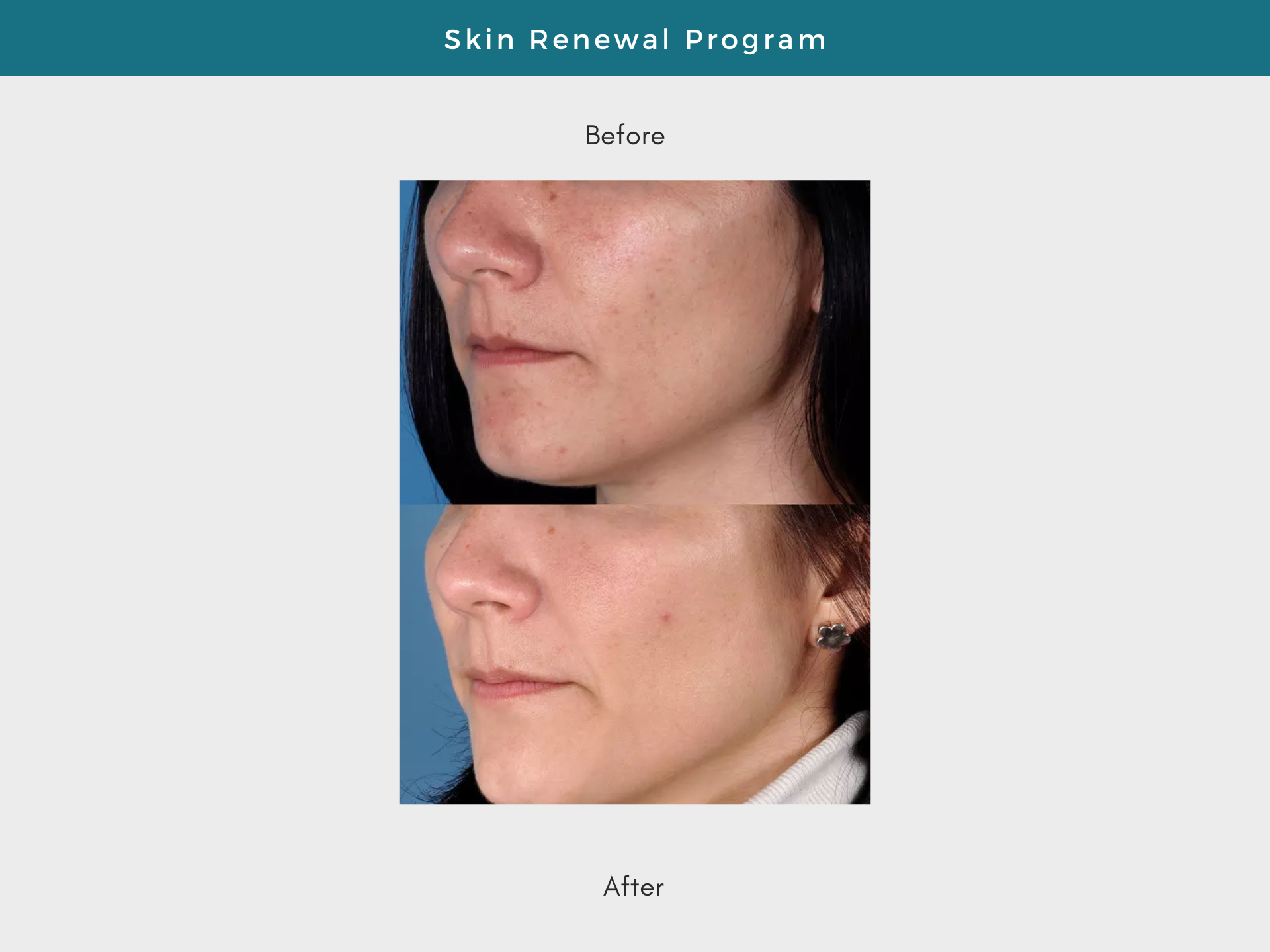 Side-by-side photos of a woman's face: before and after a skin renewal program, showing reduction in dark spots.