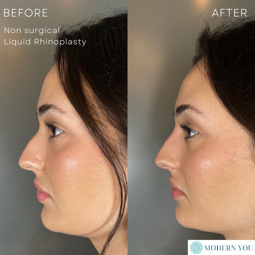 Side-by-side comparison of a woman's profile before and after a non-surgical liquid rhinoplasty to reshape her nose.