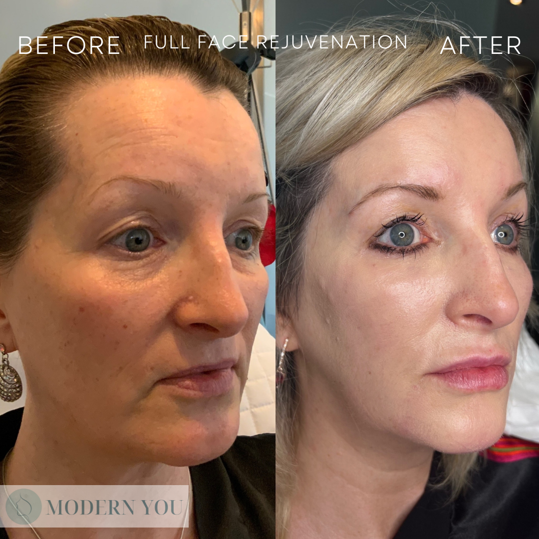 Side-by-side comparison: Woman's face before/after 