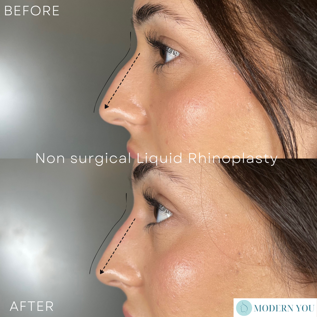 Before & after views of a woman's nose, showing changes after a non-surgical liquid rhinoplasty.