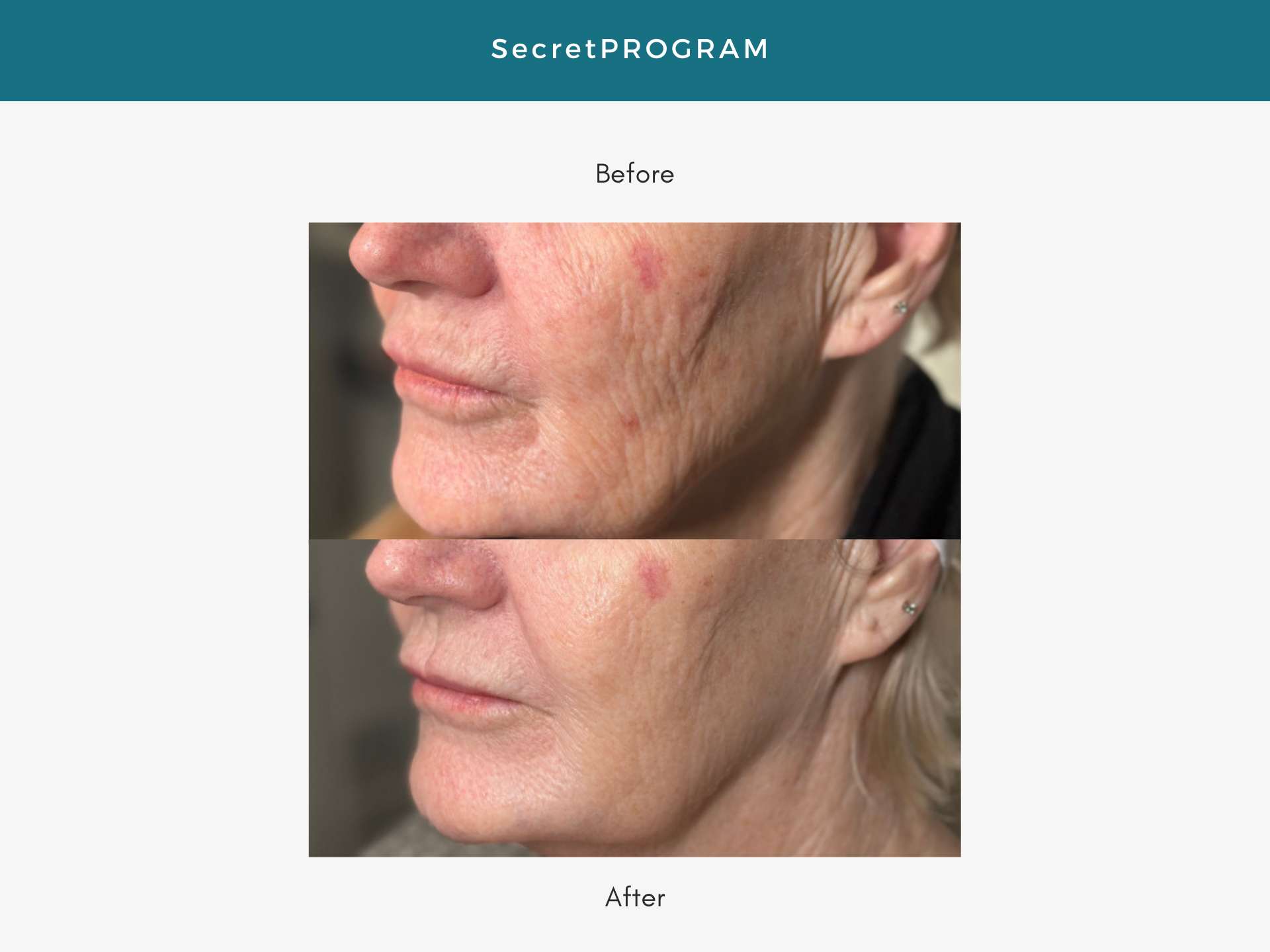 Side-by-side before and after photos of a woman's face. The "after" photo shows fewer wrinkles and smoother skin.