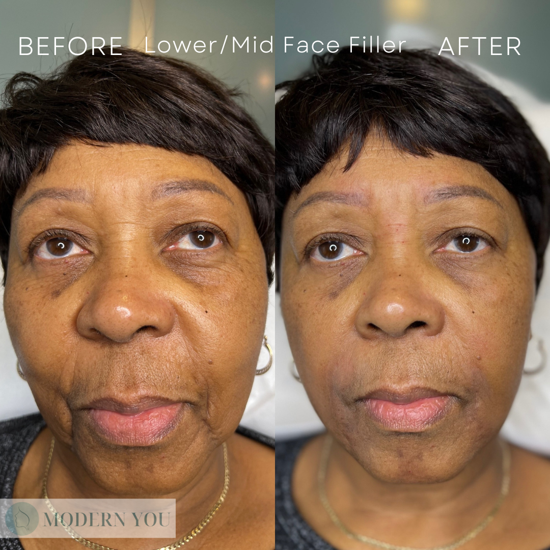 Side-by-side before and after photos of a woman's face after lower/mid face filler; wrinkles reduced, volume added.