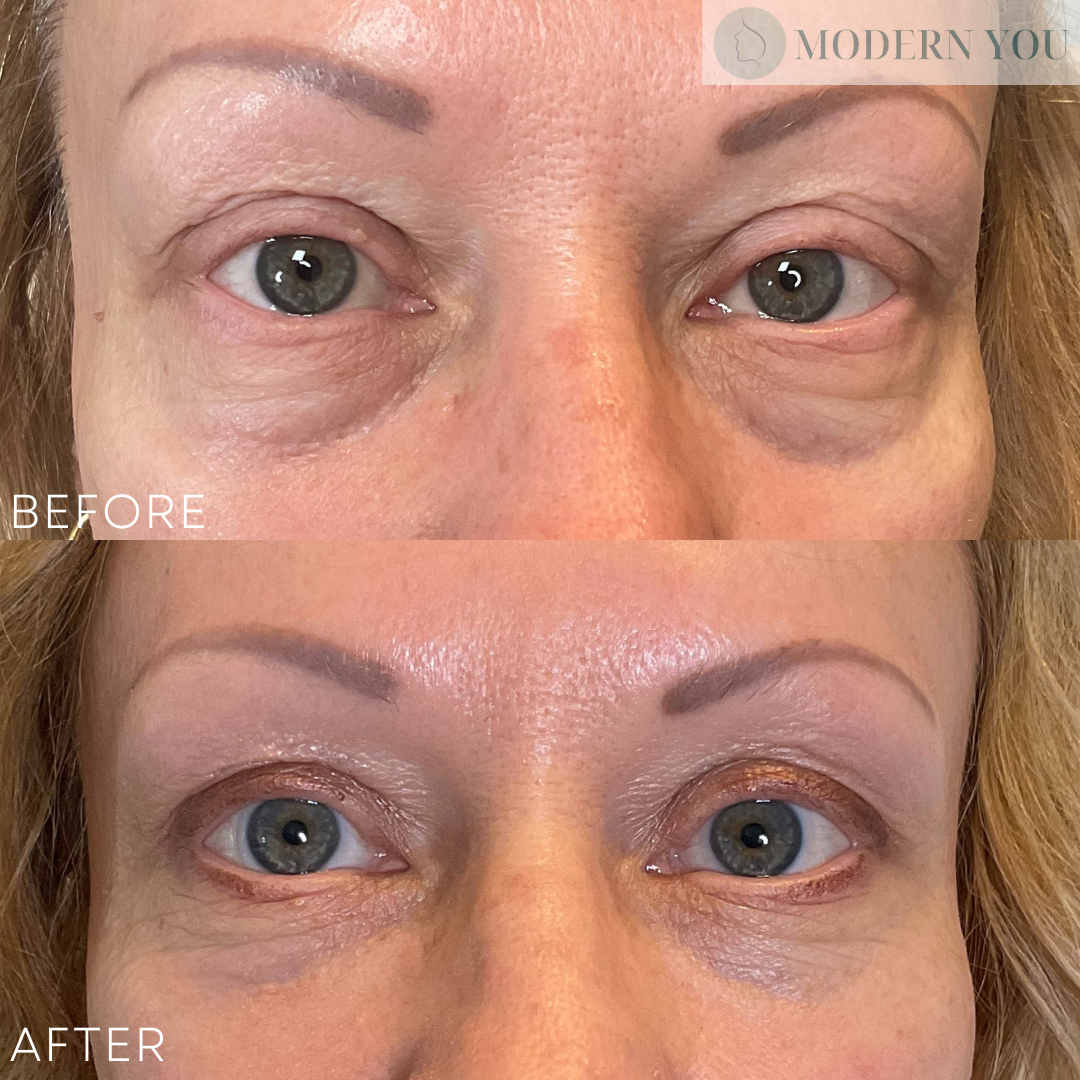 Side-by-side comparison of woman's eyes, before and after treatment to reduce under-eye bags and dark circles.