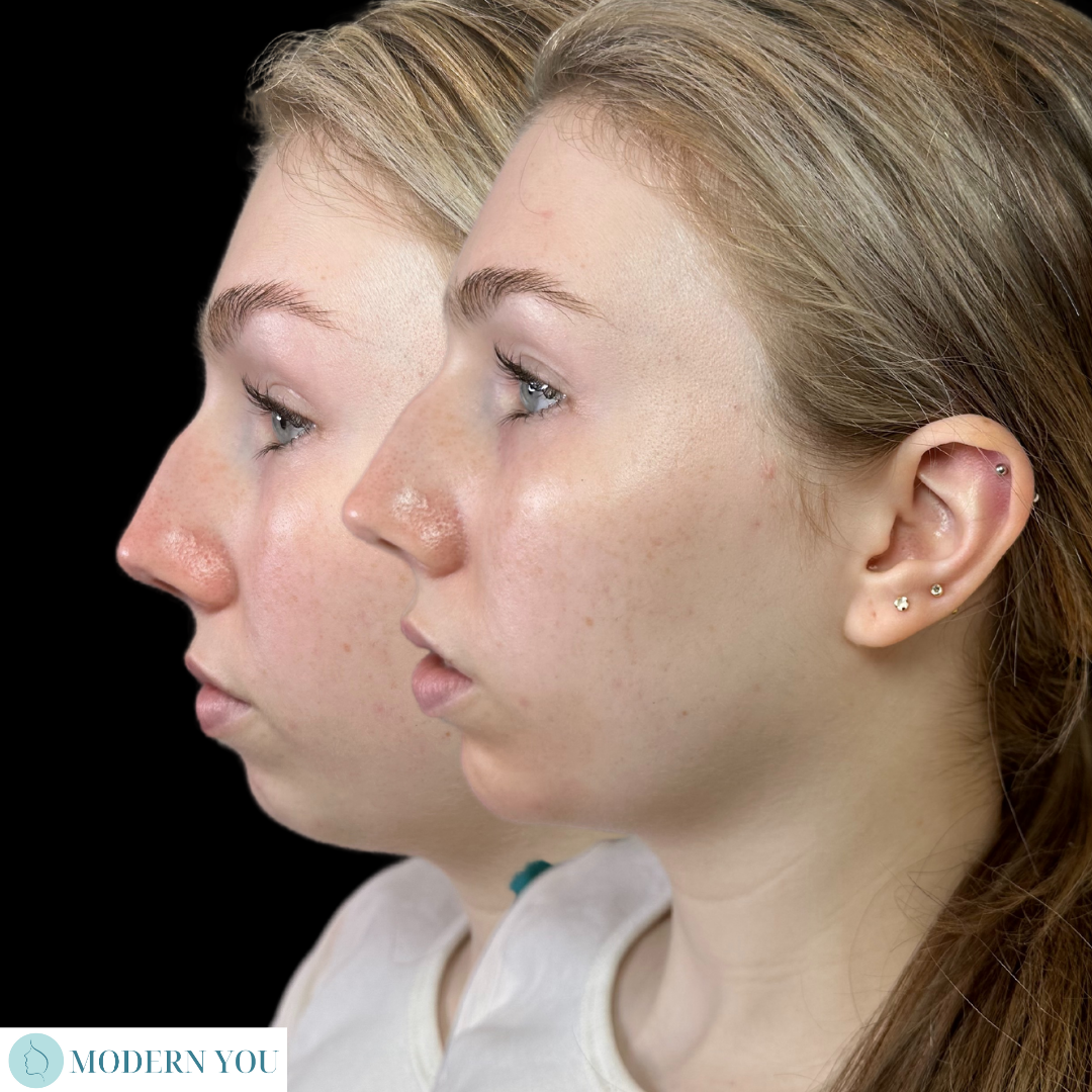 Side-by-side photo: Woman before and after rhinoplasty. Right image shows refined nose profile.
