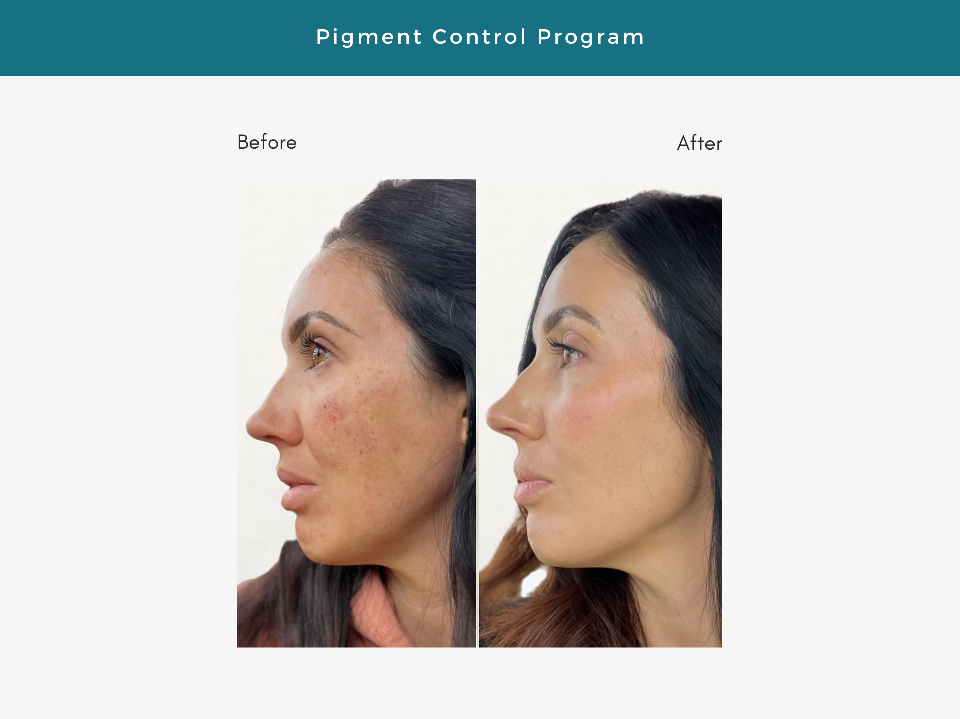 Before-and-after view of woman's profile. Pigment Control Program results show reduced dark spots on skin.