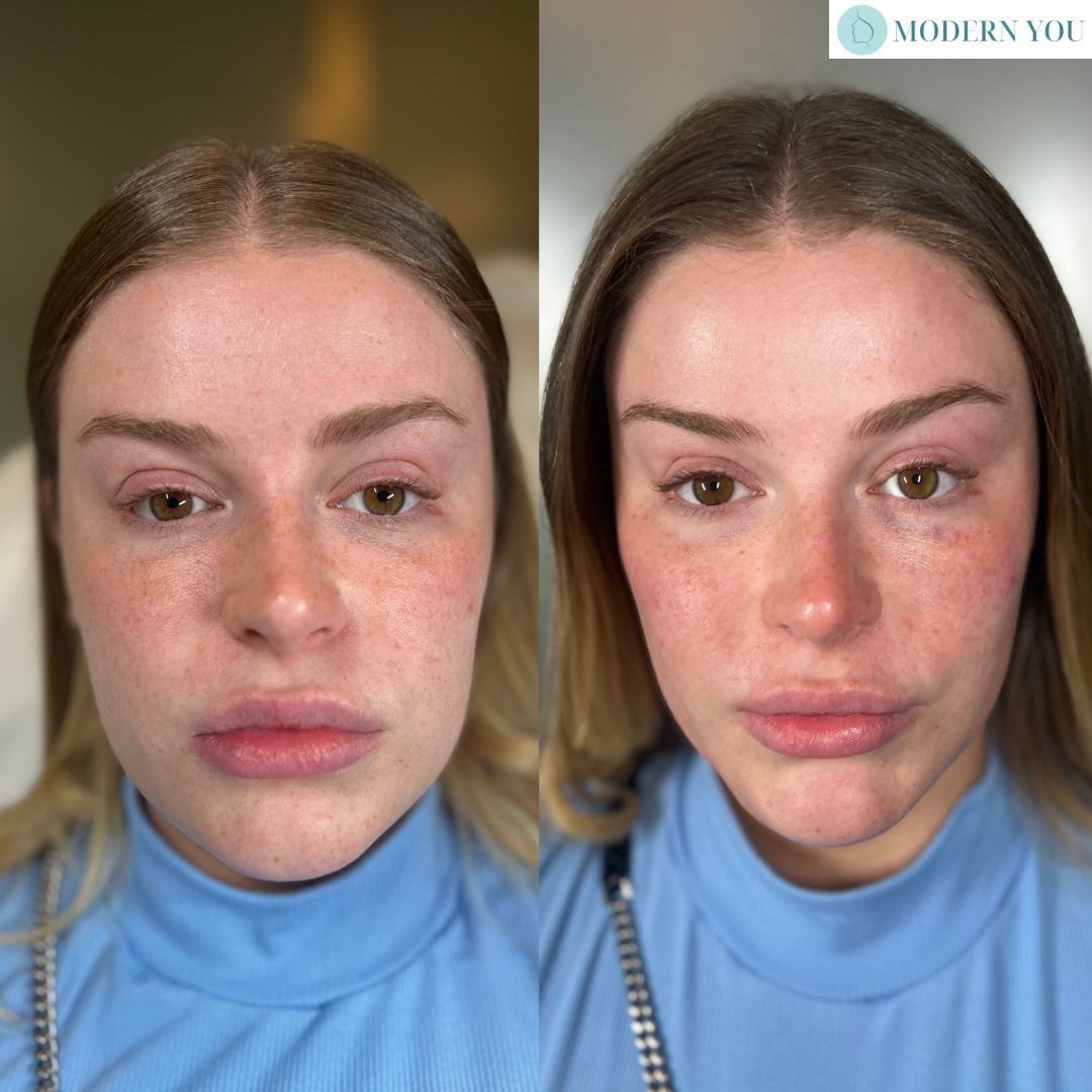 Before and after facial shot of a woman. The right side showing fuller lips and cheeks.
