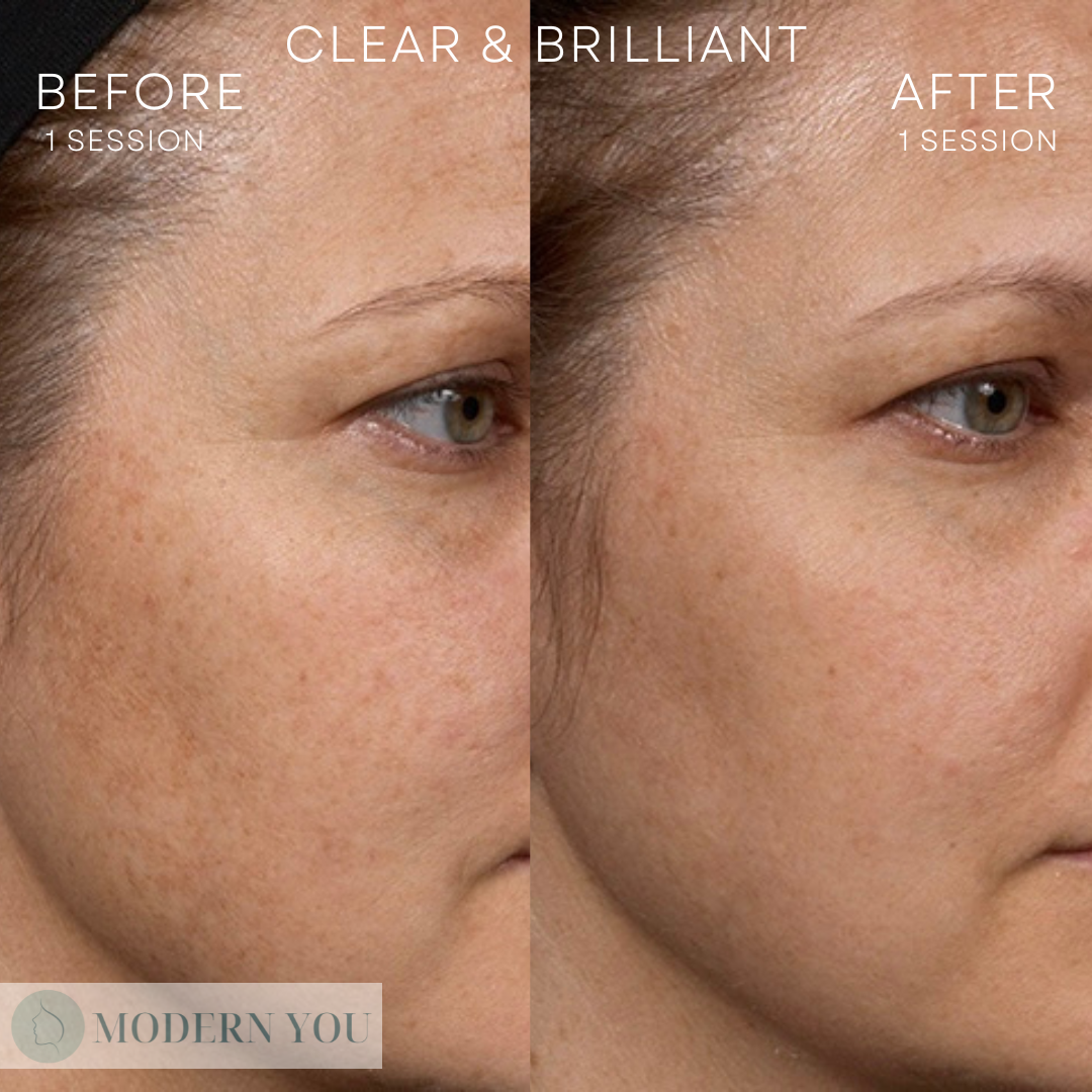 Before and after photos of a woman's face, showing reduced sunspots and improved skin tone after Clear + Brilliant treatment.