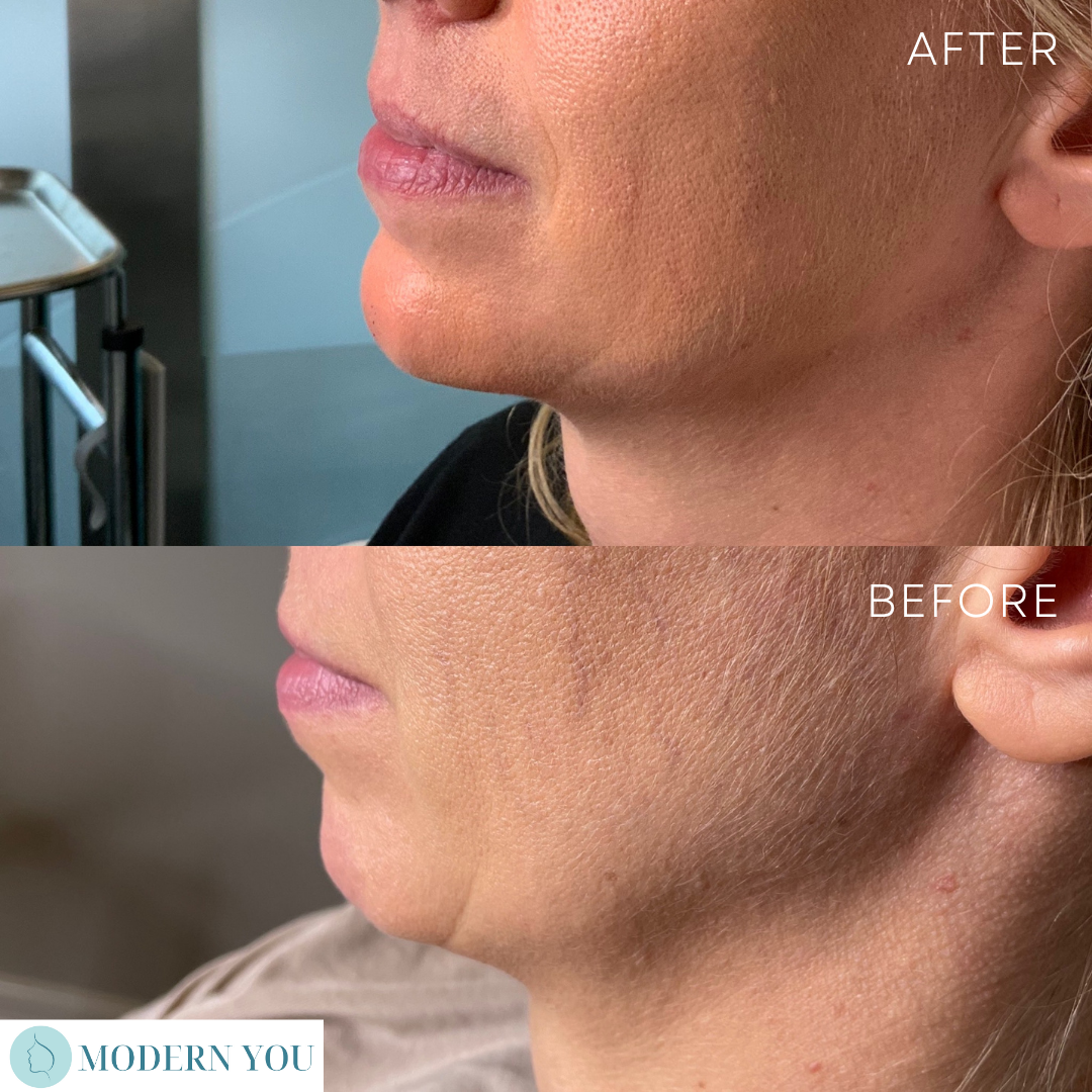 Before and after comparison of a woman's chin/neck area; shows reduction of sagging skin.