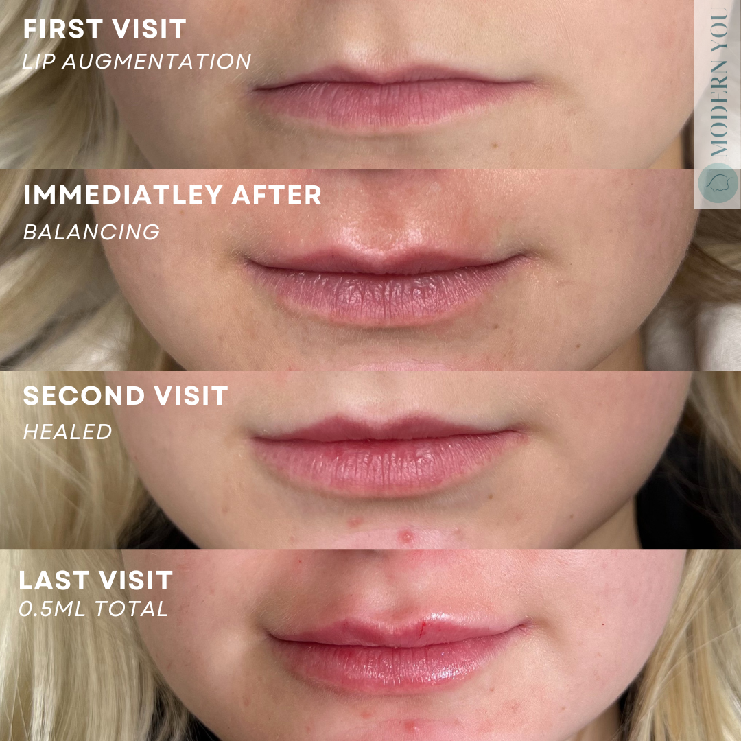 Lip augmentation progress: Before, immediately after, healed, and final results. Shows fuller lips over time.