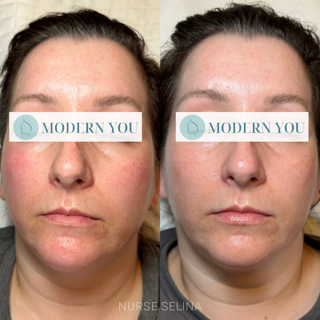 Before-and-after comparison of a woman's face, showing reduction of redness and blemishes.
