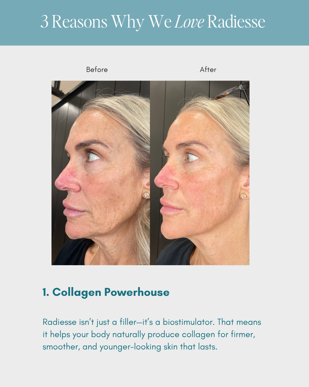 Before-and-after side-profile photos showing smoother skin in the after image
