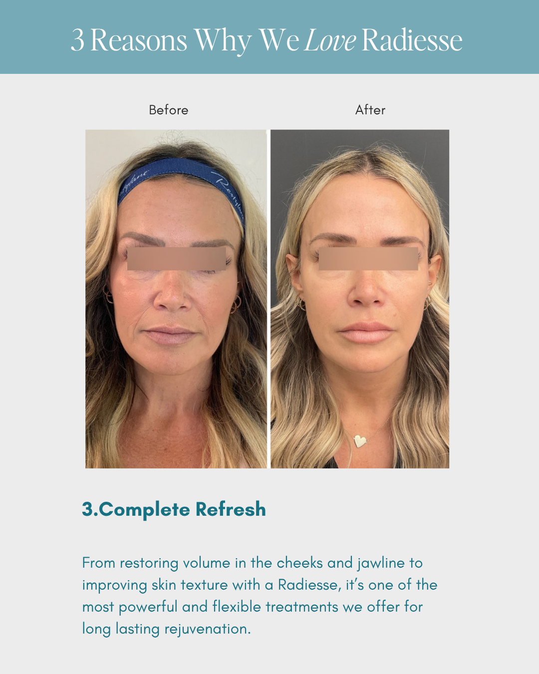 Before-and-after skincare ad with two face photos and the heading “3 Reasons Why We Love Radiesse”