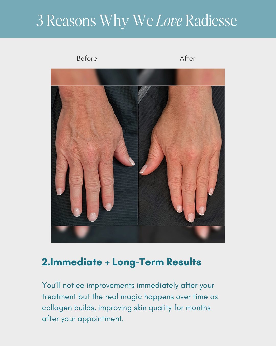 Before-and-after close-up of hands showing smoother skin and fewer wrinkles after treatment