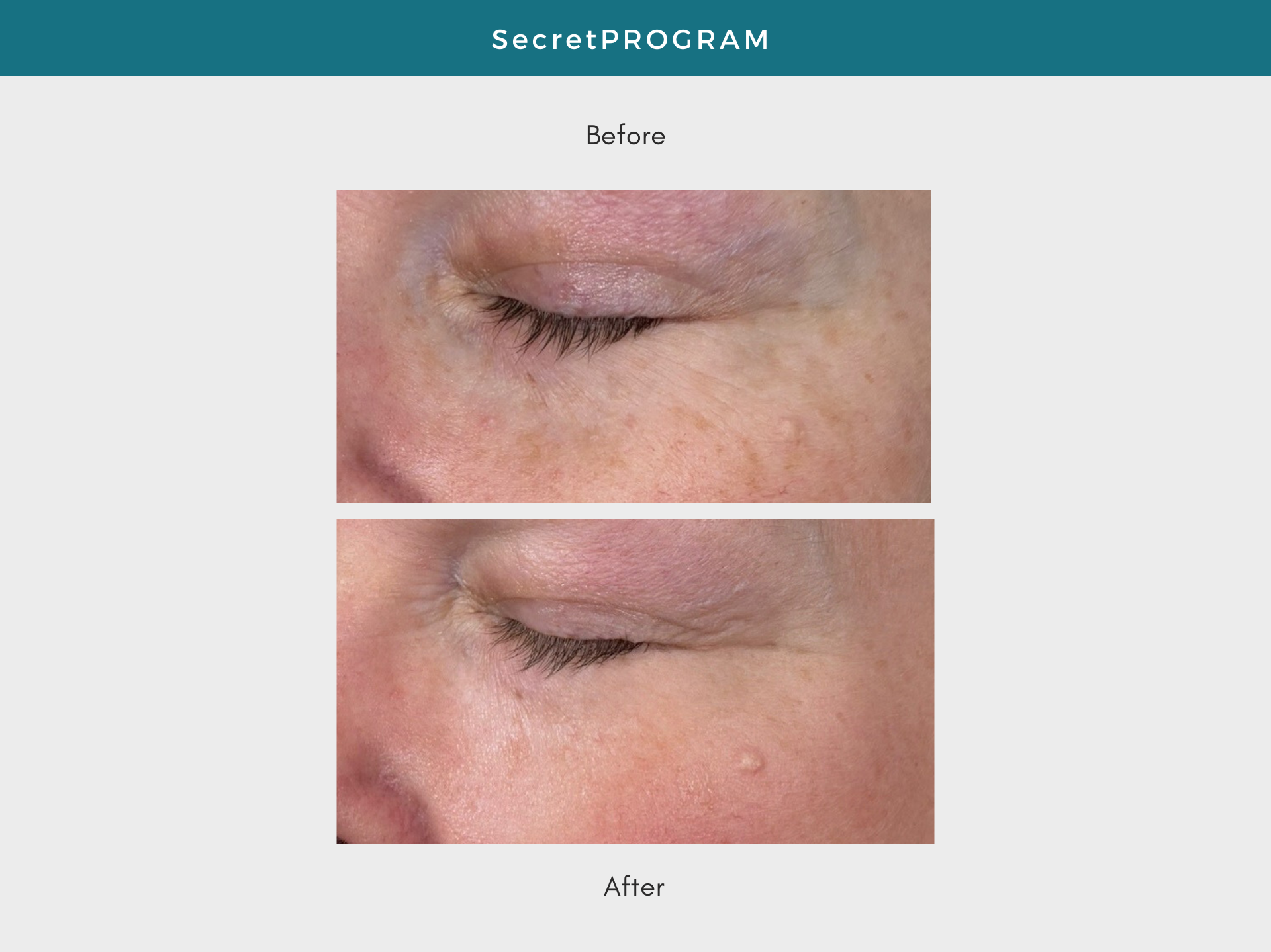 Before-and-after comparison of a person's eye. The 'before' shows skin discoloration, the 'after' shows improved skin.