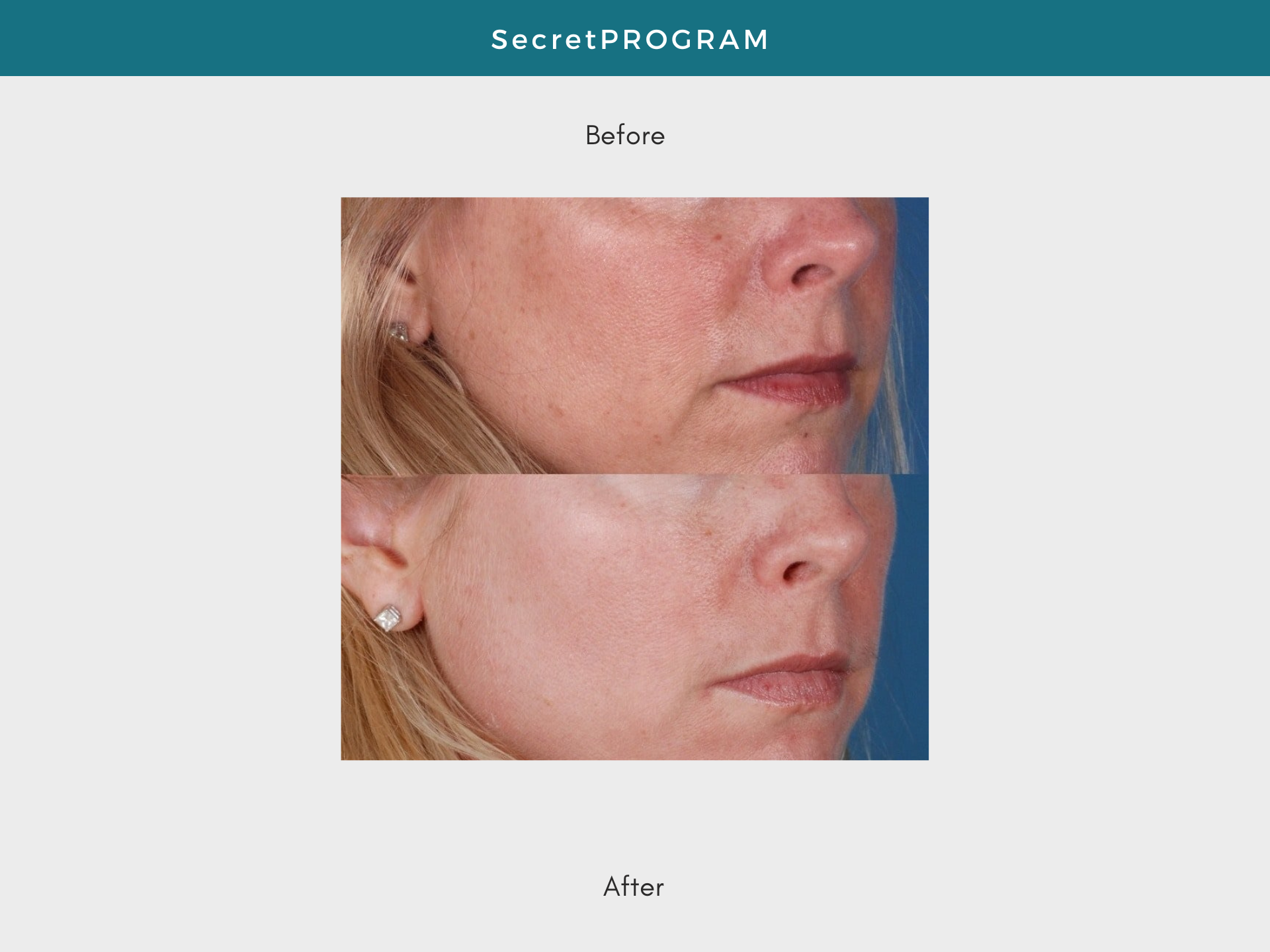 Before-and-after comparison of a woman's face. Redness and wrinkles visible in the